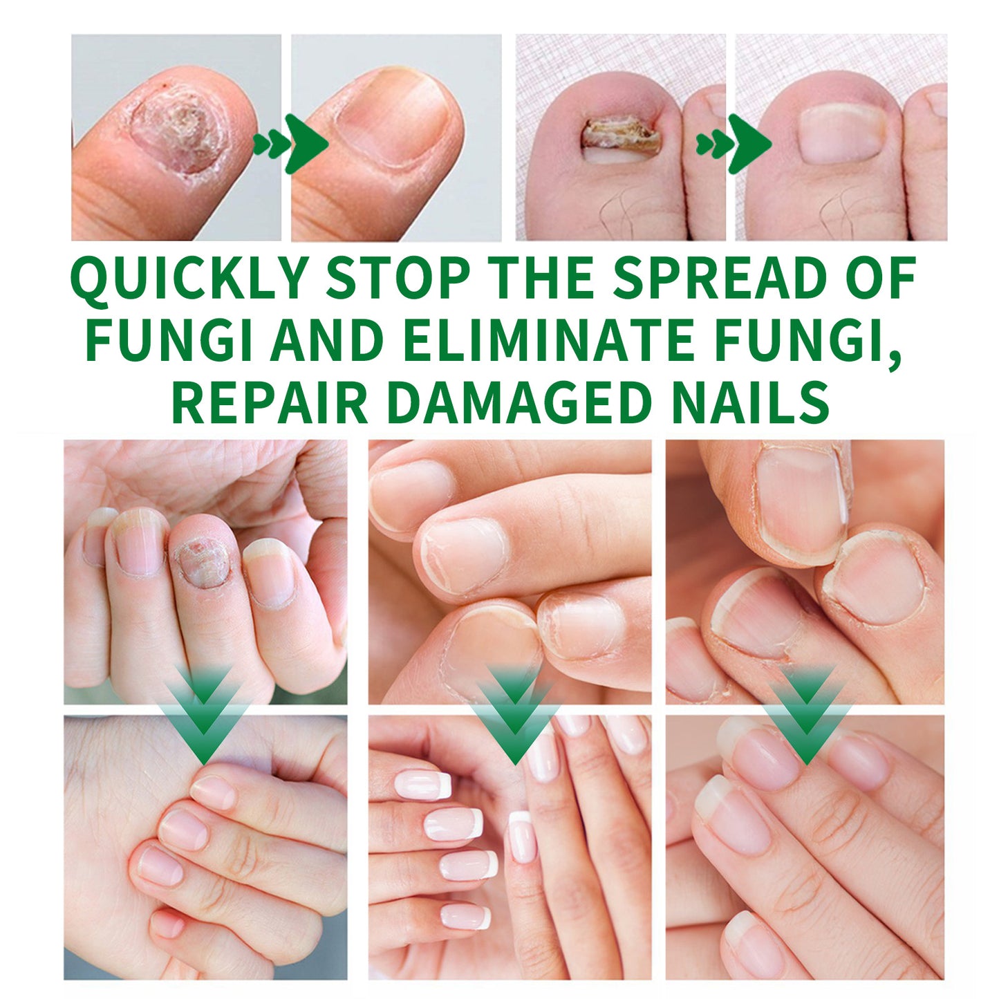 1-5Pcs Nail Fungal Treatment Device 7 Days Repair Oil Foot Toe Essence Anti Infection Paronychia Ginger Onychomycosis Gel Care